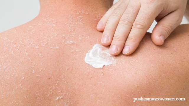 Tips Cara Menjaga Kesehatan Kulit Agar Tidak Terkelupas