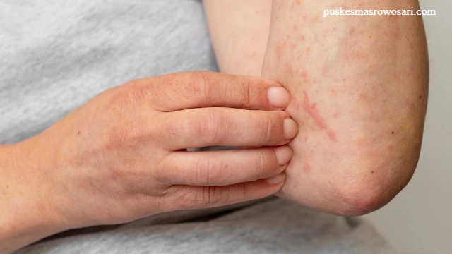 Jenis Penyakit Kulit Menular dan Tidak Menular